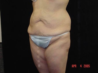 Body Lift with Liposuction of Abdomen, Waist, Flanks