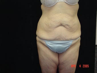 Body Lift with Liposuction of Abdomen, Waist, Flanks