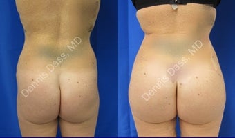 Buttock augmentation