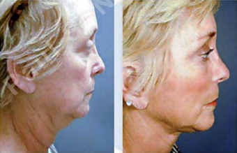 Complete Facial Rejuvenation