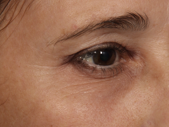 Thermage CPT to Eyes