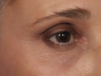 Thermage CPT to Eyes