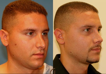 Revision Rhinoplasty