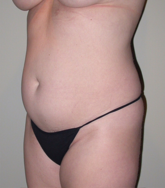 VASER liposelection