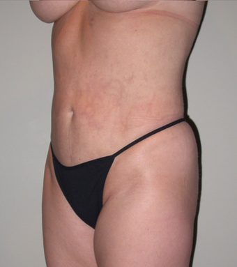 VASER liposelection