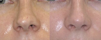 Revision Rhinoplasty
