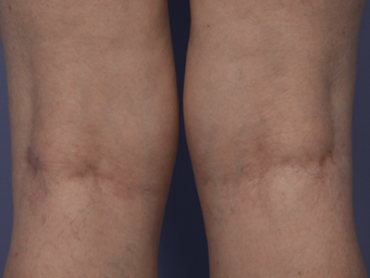 Laser Vein