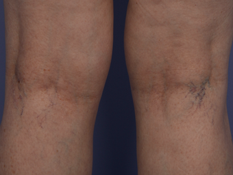 Laser Vein