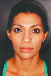 Septorhinoplasty