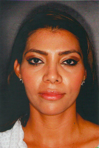 Septorhinoplasty