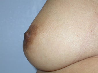 Nipple Reduction