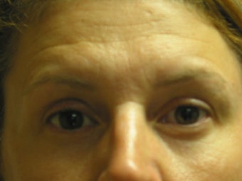 Liquid Facelift with Radiesse