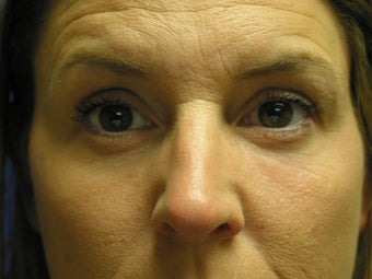 Liquid Facelift with Radiesse