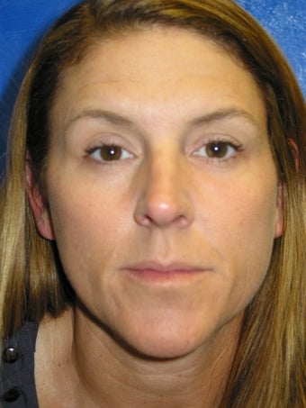 Liquid Facelift with Radiesse