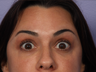 Botox to Forehead