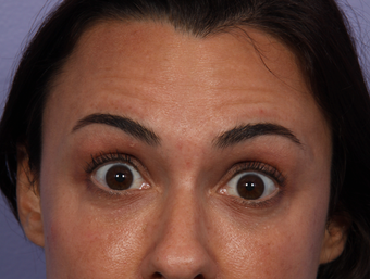 Botox to Forehead
