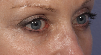 Eyelid Surgery