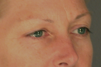 Eyelid Surgery