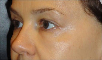 Restylane