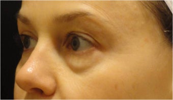 Restylane