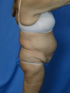 Circumferential Tuck