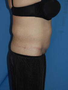 Circumferential Tuck
