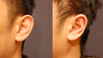 Male otoplasty