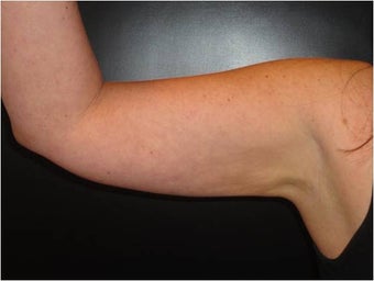 SmartLipo MPX