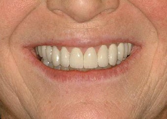 Full Mouth Reconstruction