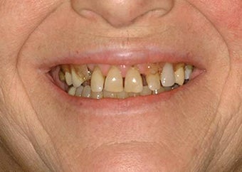 Full Mouth Reconstruction