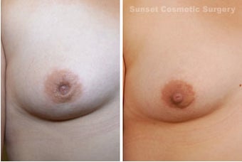 Inverted Nipple Repair