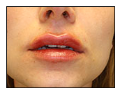 Injectables