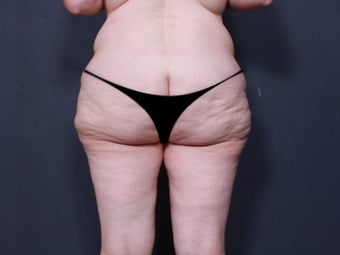 Body Lift