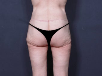 Body Lift