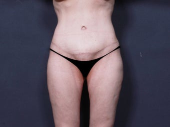 Body Lift