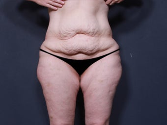 Body Lift