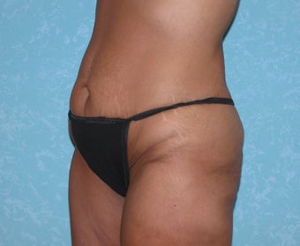 Circumferential Body Lift