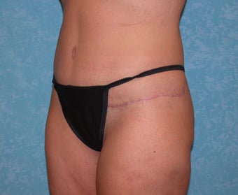Circumferential Body Lift