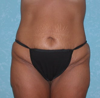 Circumferential Body Lift
