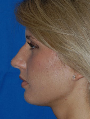 Refinement Rhinoplasty