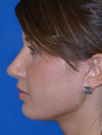Refinement Rhinoplasty