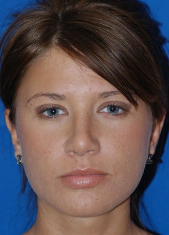 Refinement Rhinoplasty