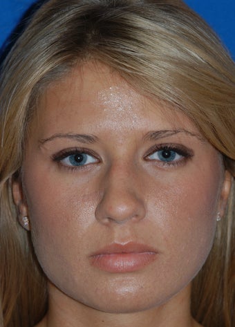 Refinement Rhinoplasty