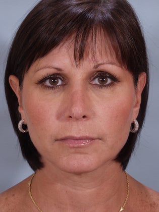 Revision Rhinoplasty 
