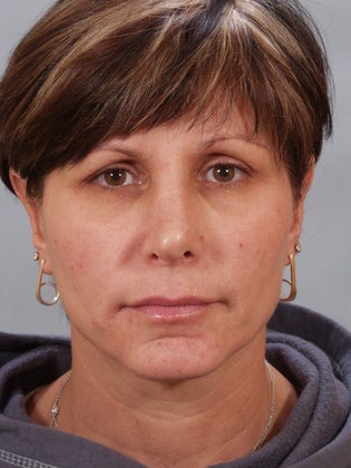 Revision Rhinoplasty 