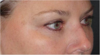 Restylane