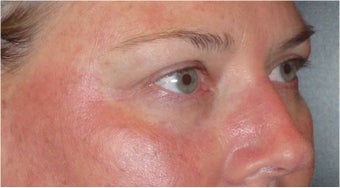 Restylane