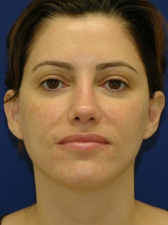 35 year old treated for Upper eyelid hollowing