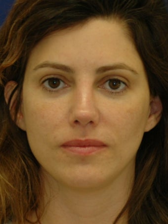 35 year old treated for Upper eyelid hollowing