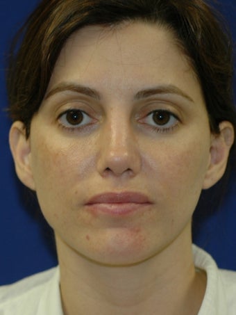 35 year old treated for Upper eyelid hollowing
